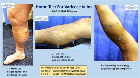 manual compression test veins|varicose veins treatment pdf.